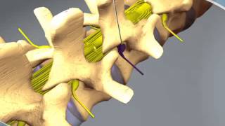 What to expect during a Nerve Root Block at RAYUS [upl. by Sixela]