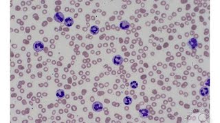 Chronic Neutrophilic Leukemia CNL [upl. by Mosenthal974]