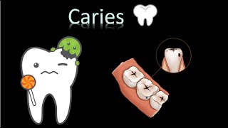 🦷 Caries Dental  Cavidad oral  Cabeza y Cuello  Patología [upl. by Bernt596]