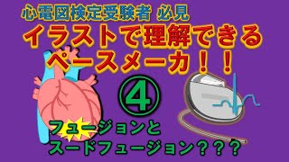 ペースメーカ苦手な人集まれ！④「フュージョンって何？」 [upl. by Sweeney]