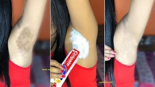 5 मिनट में अंडरआर्मस और गर्दन का कालापन दूर करने का जबरदस्त उपाय  Whiten Dark Underarms Instantly [upl. by Ayetal773]