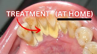 Gingivitis HOME Treatment Did Your Dentist Lie To You [upl. by Keir]