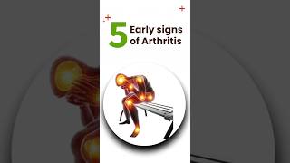 5 Early signs of Arthritis arthritis jointpain ytshorts [upl. by Tennies]