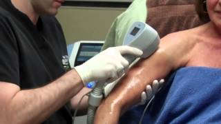 Exilis for Skin Tightening on a Womans Arms with Dr Seiler [upl. by Aisyram]