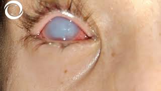 Ophthalmic Signs Cornea [upl. by Navarro]