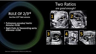 Assessment of Severity of TOF on Fetal Echo [upl. by Palmore]