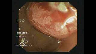 Pancreatic Duct PD Dilatation [upl. by Swope]