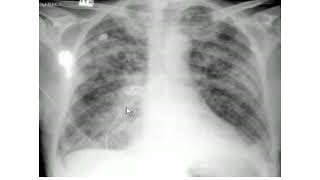 Pulmonary edema XRay review [upl. by Reisinger]