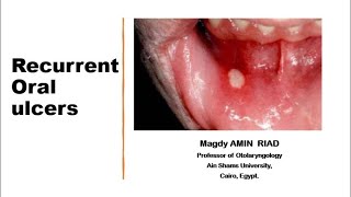 II Recurrent Oral Ulcers [upl. by Sylvan424]