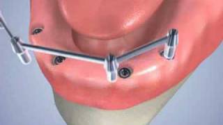 pose de 4 implants dentaires avec une barre dattachement [upl. by Penoyer]