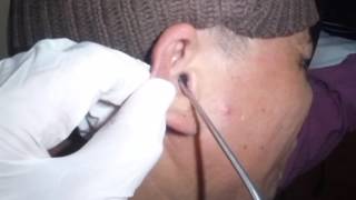 Earwax Removal and Suctioning of Ear Fungus Otomycosis [upl. by Care219]