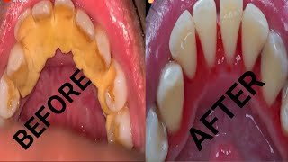 Teeth tartar remove [upl. by Ahsema]