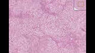 Histopathology Liver  Fatty change [upl. by Eceinaj]