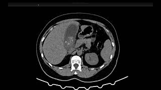 COLECISTITE AGUDA NA TOMOGRAFIA É possível sugerir [upl. by Oterol194]