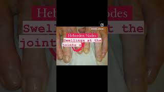 What is the meaning of Heberden Nodes  Decoded Word of The Day  Medical Terminology [upl. by Atnahc219]