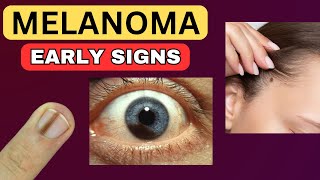 6 Weird Signs That You Have Melanoma [upl. by Fawna]