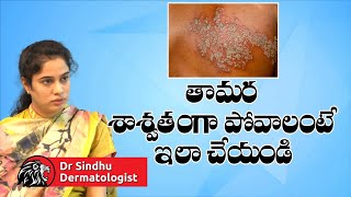 తామర శాశ్వతంగా పోవాలంటే ఇలా చేయండి  Best Treatment For Tamara Skin Disease In Telugu  Leo Health [upl. by Akimihs770]