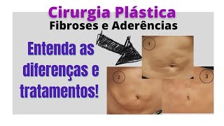 Fibroses e Aderências pós lipo abdominoplastia o que são e como melhorar [upl. by Ayalat]