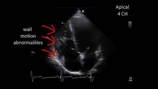 A special cardiomyopathy [upl. by Solim]