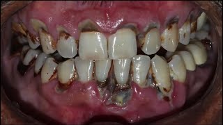 Teeth scaling to remove plaque  3d animated video  Dental Solutions Clinic Bangalore [upl. by Farmann]