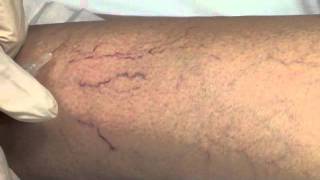 Spider Vein Sclerotherapy [upl. by Hgieleak]