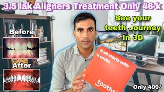 ALIGNERS Cost in India 45k  See Your teeth Journey in 3D Animation  TOOTHSI REVIEW  teeth Result [upl. by Elohcim467]