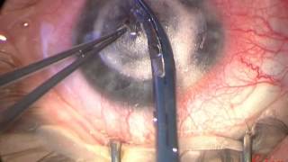 Deep Anterior Lamellar Keratoplasty with the Big Bubble Technique [upl. by Terena]