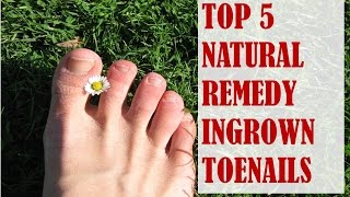 Top 5 Natural Remedies for Ingrown Toenails [upl. by Sik72]