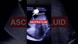 Ascites fluid radiology education best knowledgeablefact shorts [upl. by Rem]