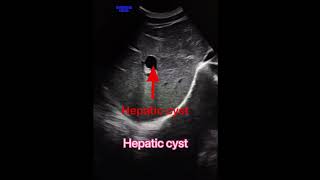 Hepatic cyst usgradiology usg4d ultrasound ultrasoundscans sonography medicalstudent medical [upl. by Cullie]