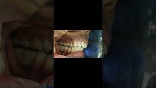 First and second mandibular molar implant bridge occlusal check for interference shorts [upl. by Calypso]