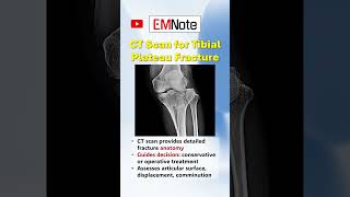 Bilateral Tibial Plateau Fractures How to Build Strength and Stability With Jumping [upl. by Giamo843]