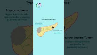 Types of Pancreatic Cancer Explained  Knowing the Different Forms  Dr Vivek Sukumar [upl. by Anisirhc54]