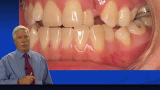 Rondeau Seminars Orthodontics Level II Sample Case  Mai Part 1 [upl. by Notseh]