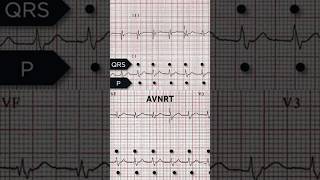 AVNRT ECG Retrograde p waves [upl. by Meece110]