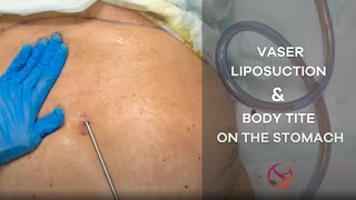 Vaser Liposuction and BodyTite on the Stomach  Dr Shalini Gupta [upl. by Nawuq985]