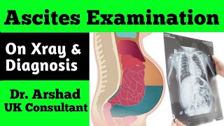 Ascites Examination on Xray and Differential Diagnosis [upl. by Ybreh]