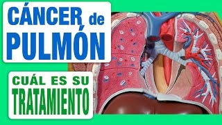 Cáncer de Pulmón  Tratamiento [upl. by Ridley205]