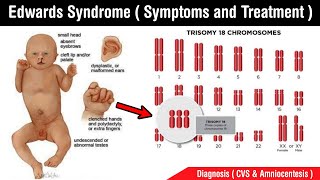 Edwards syndrome  types of Edwards syndrome  symptoms treatment diagnosis in Hindi [upl. by Penn]