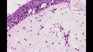 Histopathology Nose Nasal polyp [upl. by Morez412]