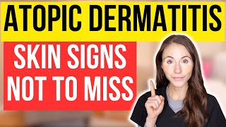 Dont Miss These 15 Signs Of Atopic Dermatitis [upl. by Leigha108]