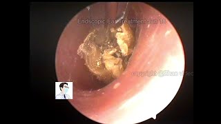 Ear Wax Removal Cerumen Cleaning Collection20220618 [upl. by Canty]