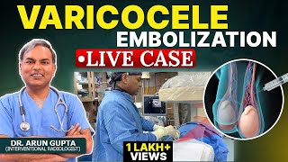 Live Case  Grade 3 Varicocele Embolization  NonSurgical Treatment of Varicocele  Dr Arun Gupta [upl. by Jumbala]