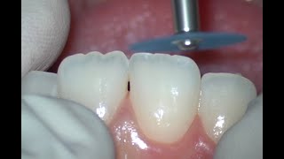 Enameloplasty Upper Central Incisors [upl. by Vashtia]