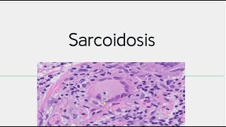 Sarcoidosis  Morphology Pathogenesis [upl. by Ettenhoj]