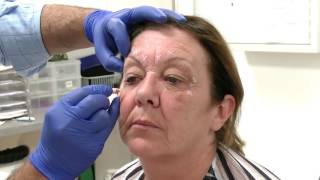 Injecting Botox into the Glabella region  Training Video For Medical Professionals Only [upl. by Julienne940]