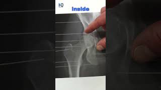 Understand Your XRay  Snapping Hip [upl. by Forrest803]