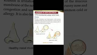 Rhinitis  typesetiologyrisk factor management complications symptoms diagnosis shorts viral [upl. by Aida]