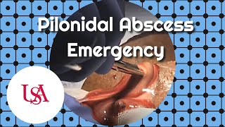 Pilonidal Abscess Emergency Incision amp Drainage [upl. by Hakilam]