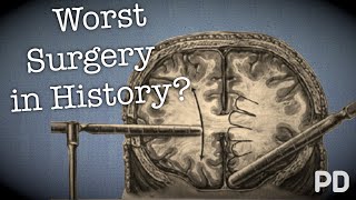 The Dark side of Science The Lobotomy the worst surgery in history Documentary [upl. by Eelytsirk]